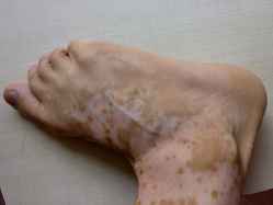 脚部出现白癜风症状的白斑的原因有哪些